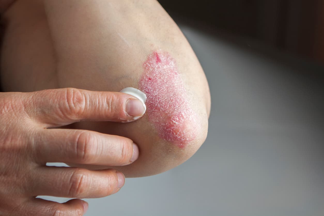 Psoriasis on elbow stock photo